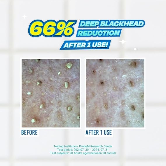 Blackhead Melting Softener Special Set [2 pcs]